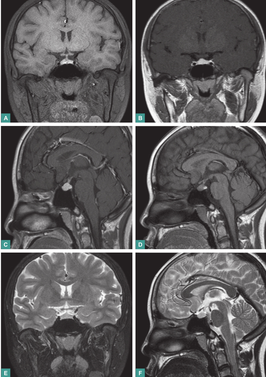 图2 垂体MRI